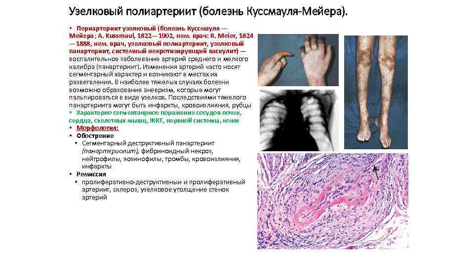 Узелковый полиартериит (болезнь Куссмауля-Мейера). • Периартериит узелковый (болезнь Куссмауля — Мейера; A. Kussmaul, 1822—