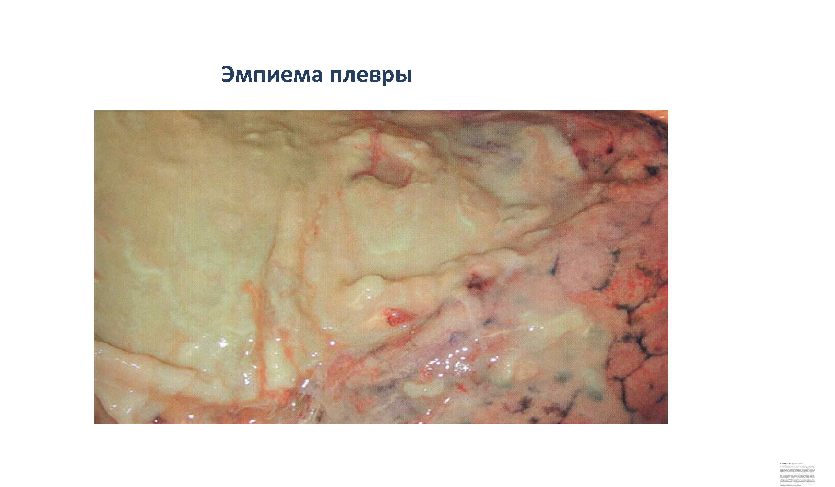Эмпиема плевры 