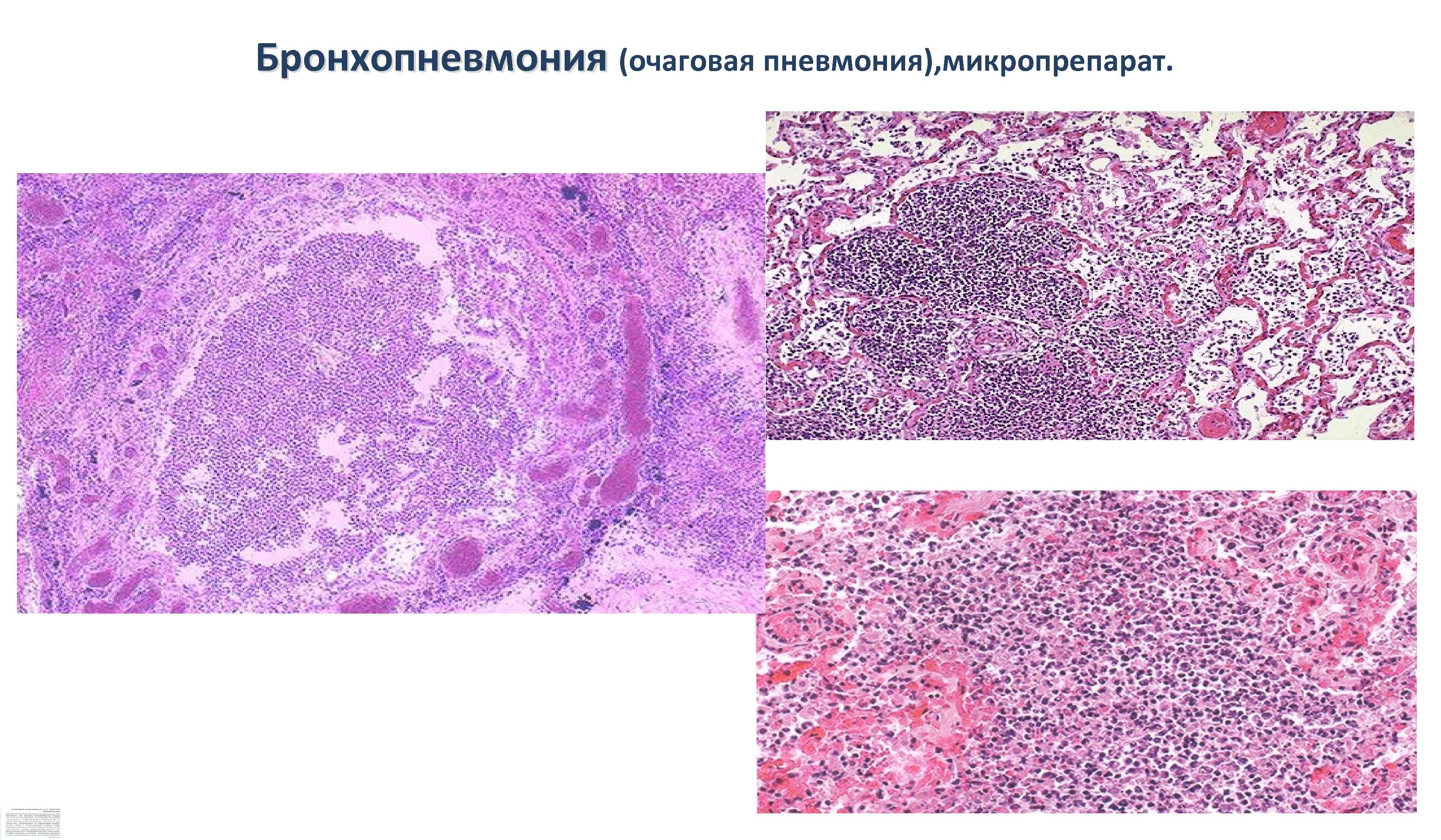 Очаговая пневмония рисунок микропрепарат