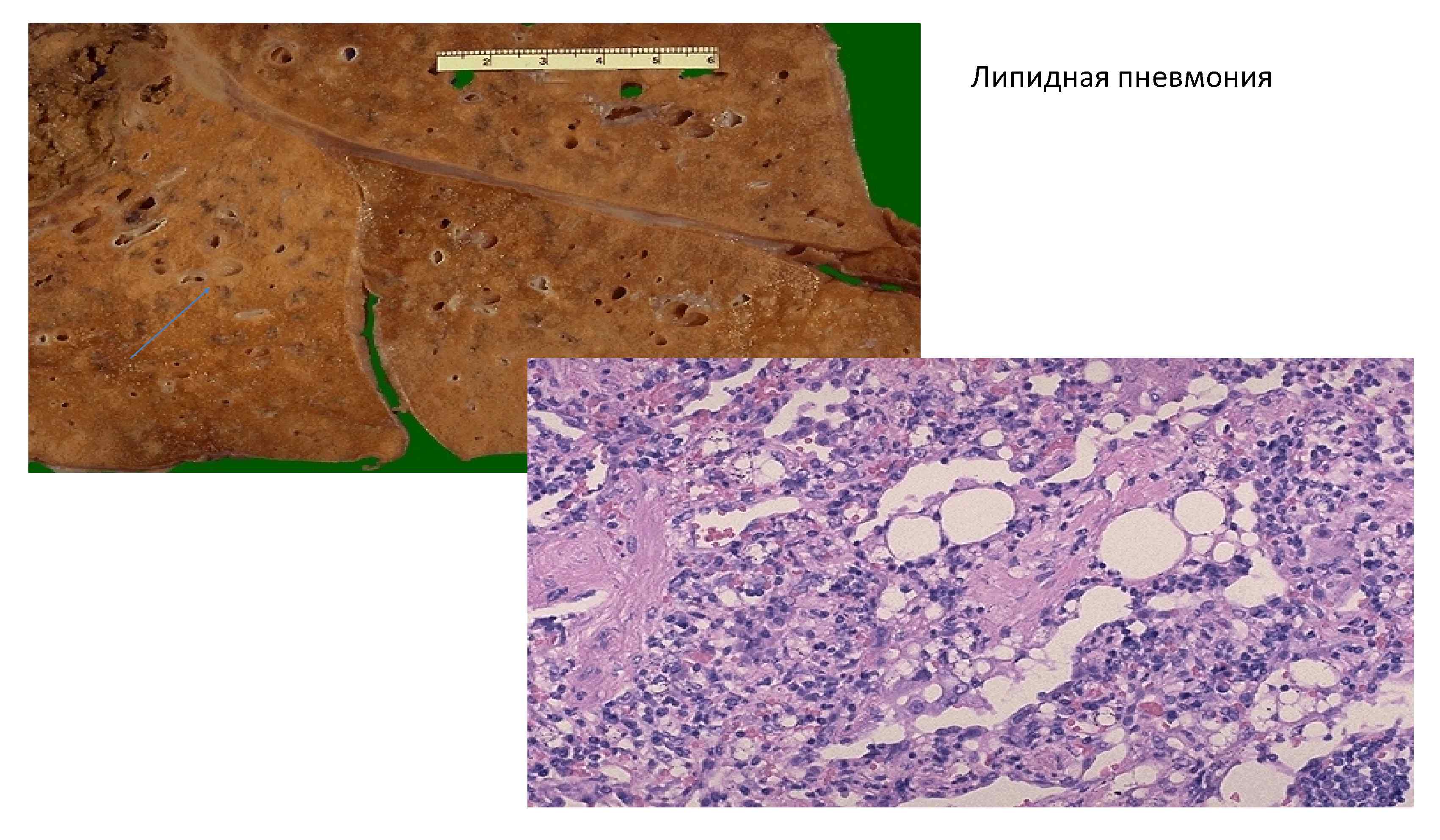 Пневмония микропрепарат описание. Бронхопневмония патанатомия макропрепарат. Крупозная пневмония макропрепарат. Эмфизема патанатомия макропрепарат. Интерстициальная пневмония патанатомия микропрепарат.