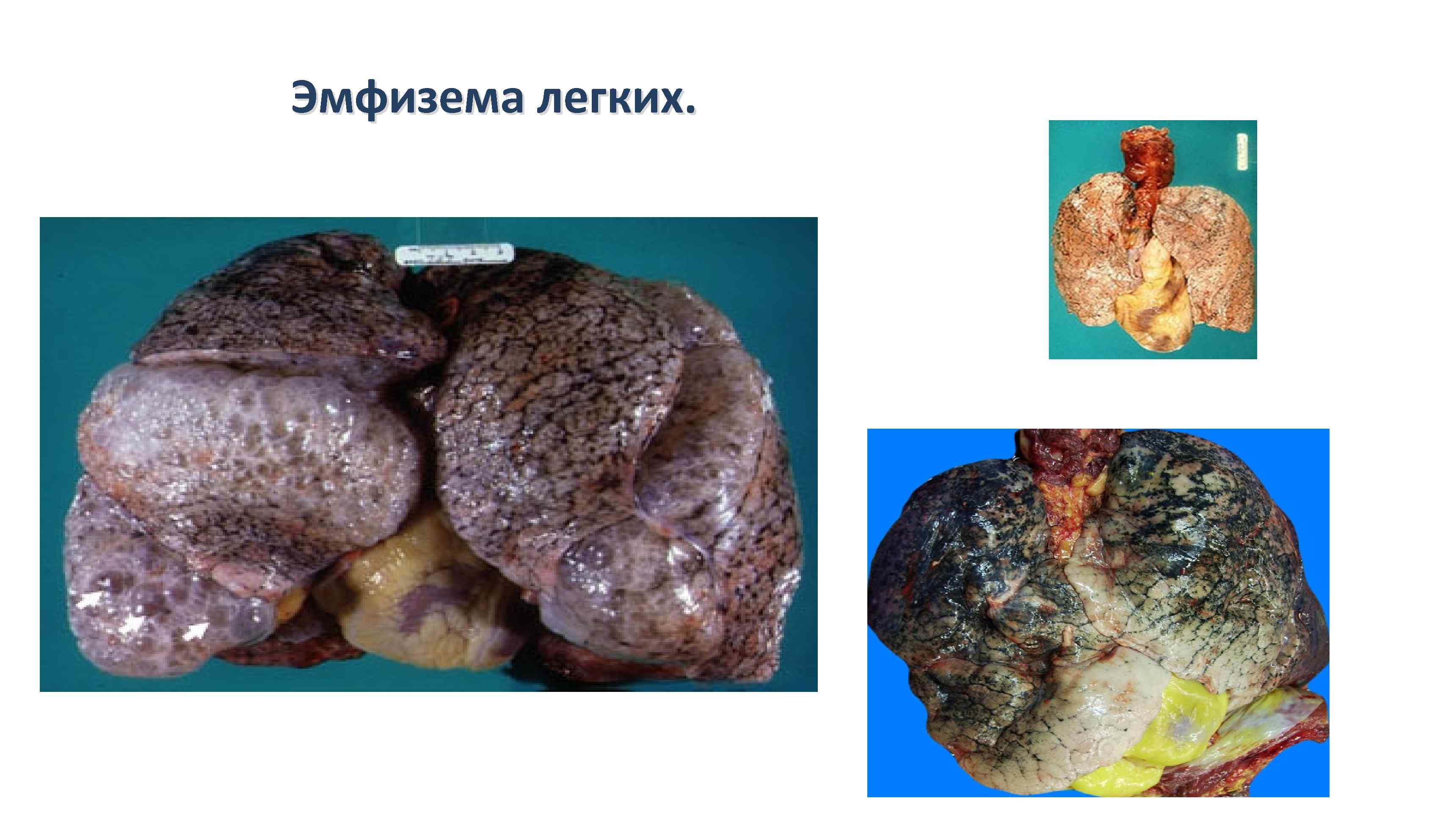 ЗАБОЛЕВАНИЯ ОРГАНОВ ДЫХАНИЯ Крупозная пневмония макропрепарат