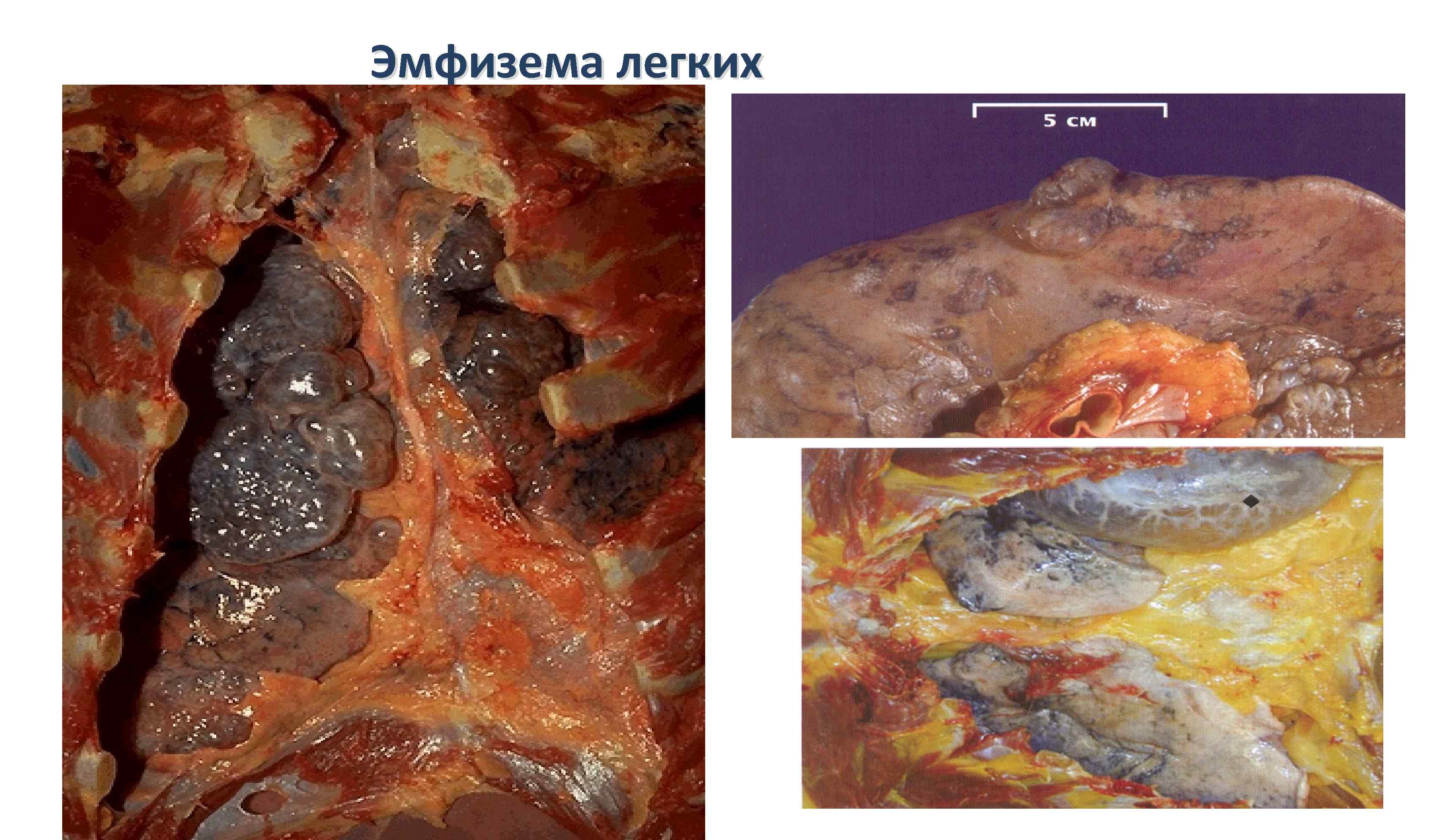 Эмфизема легких 