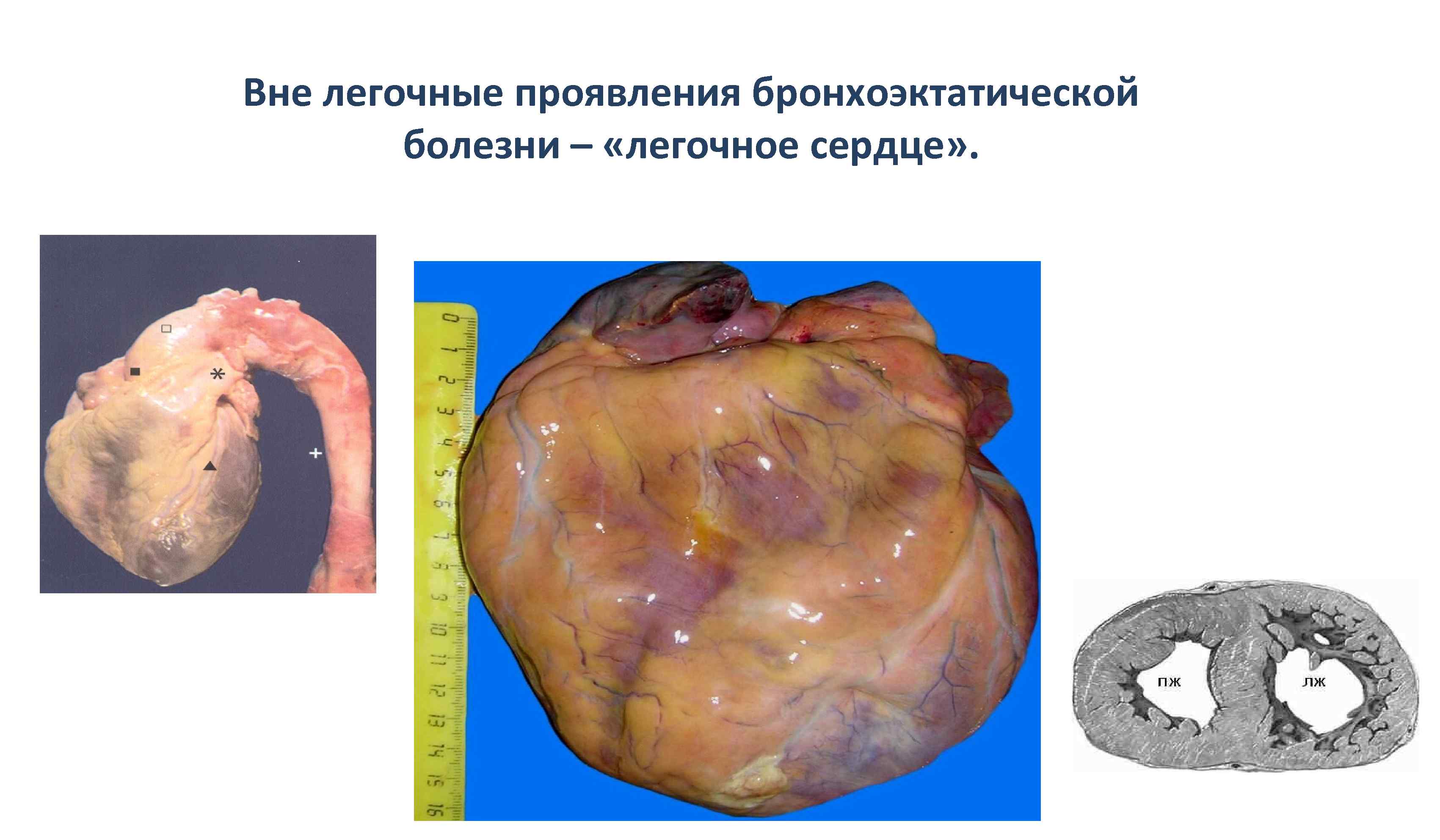 Вне легочные проявления бронхоэктатической болезни – «легочное сердце» . 
