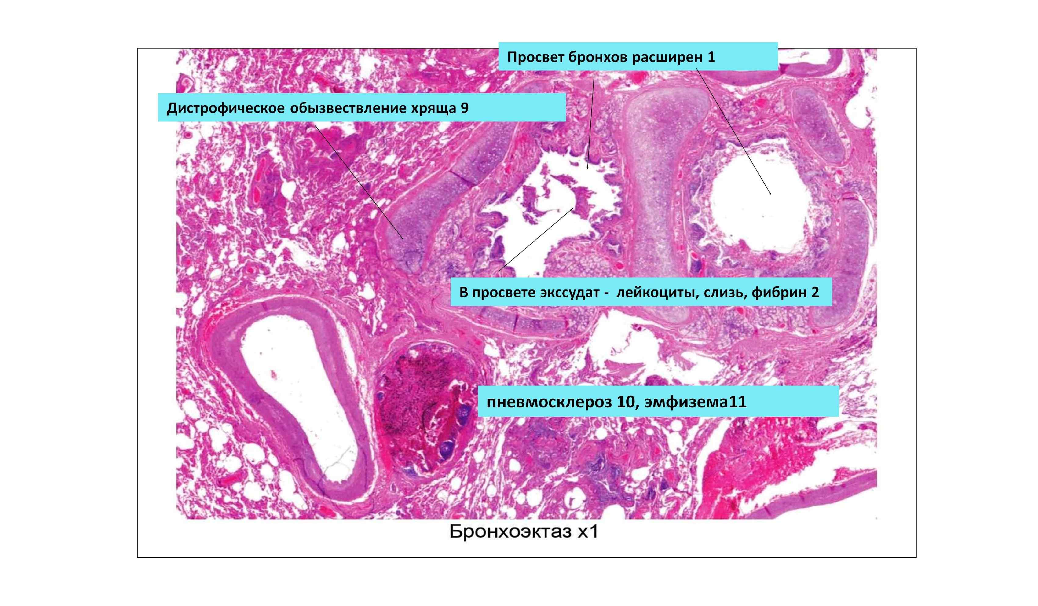 Просвет бронхов. Бронхоэктатическая болезнь макропрепарат. Бронхоэктатическая болезнь макропре. Хронический бронхит с бронхоэктазами микропрепарат. Хронический бронхит бронхоэктаз микропрепарат.