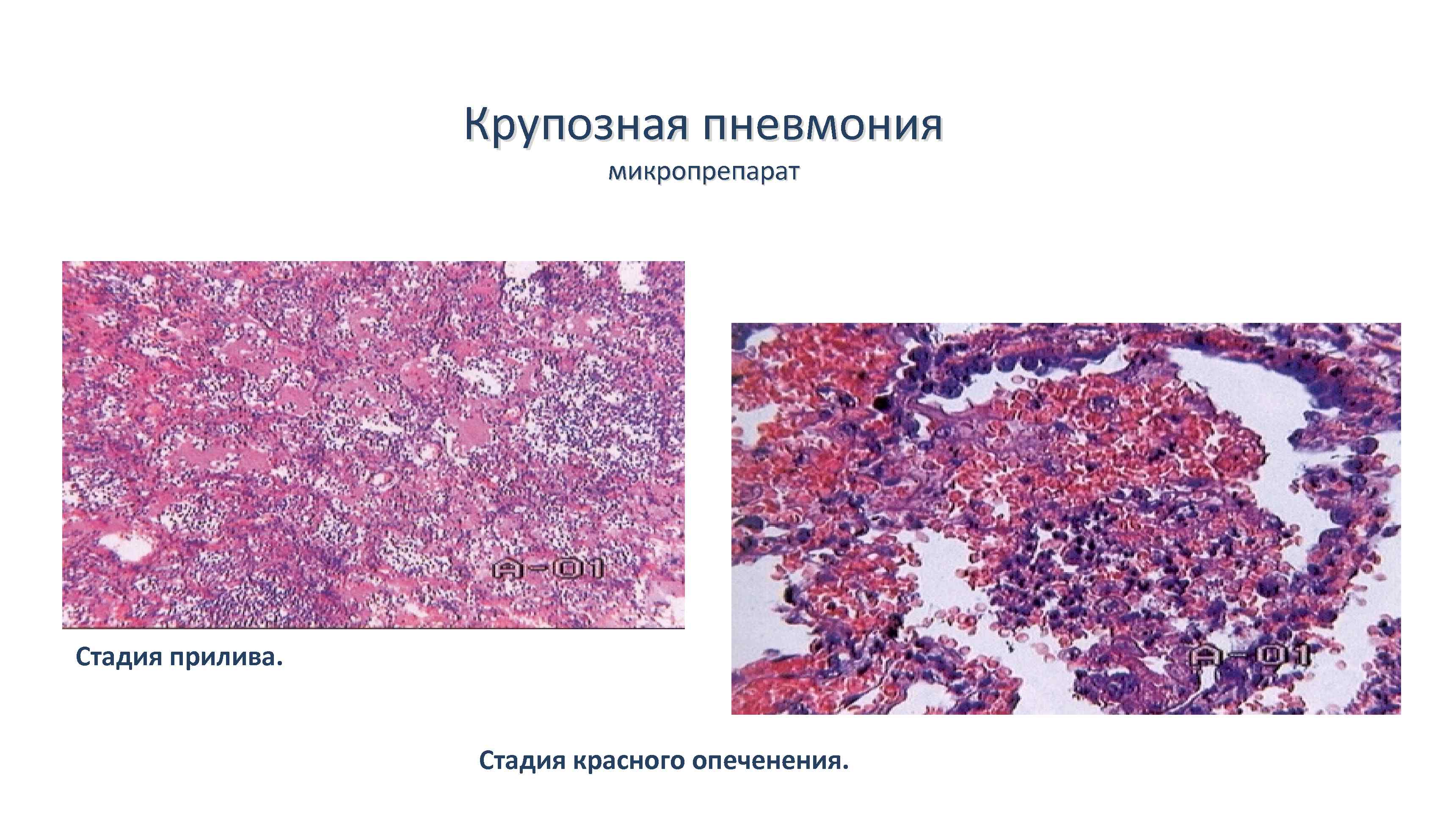 Очаговая пневмония рисунок микропрепарат