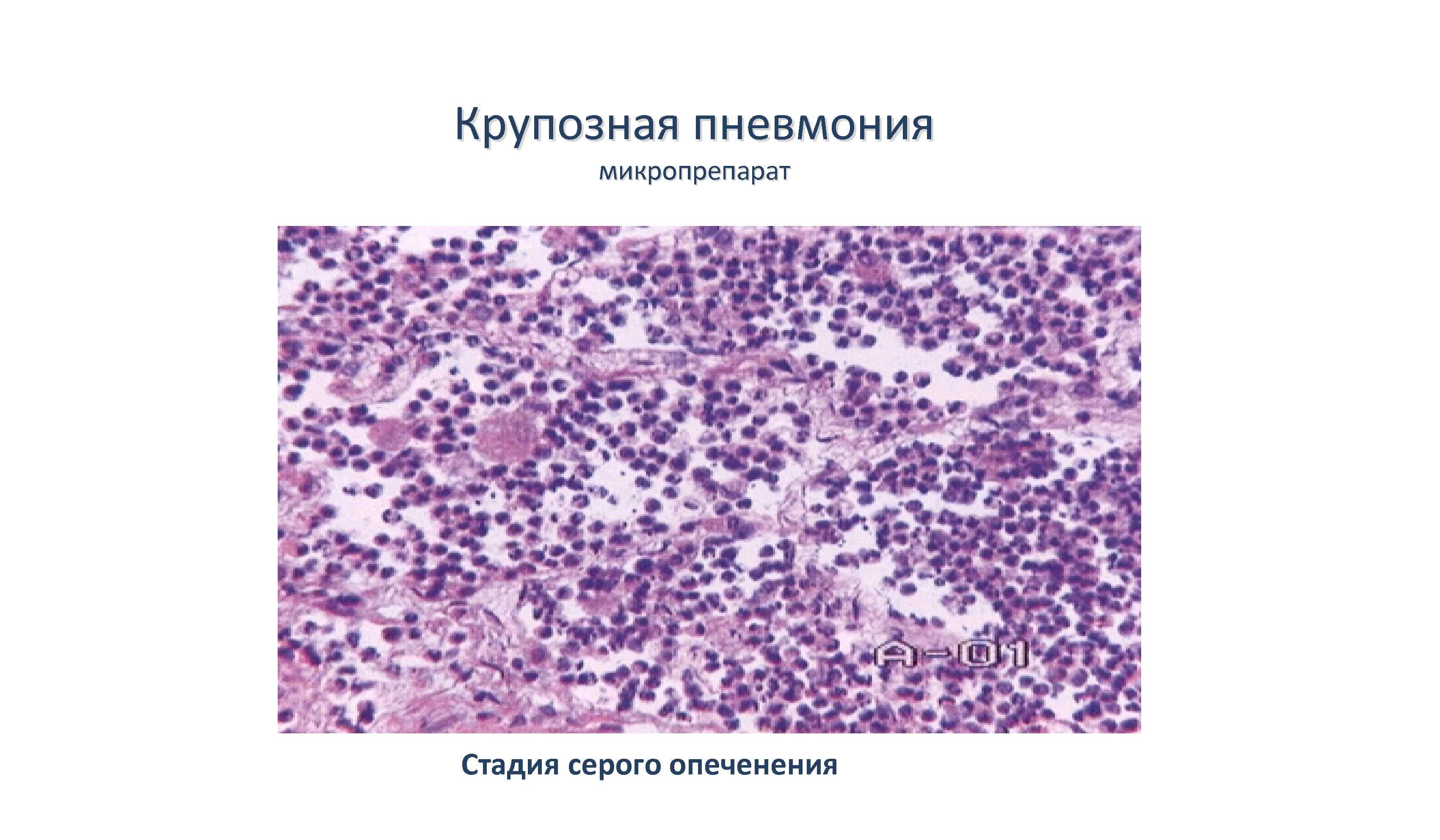 Очаговая пневмония рисунок микропрепарат