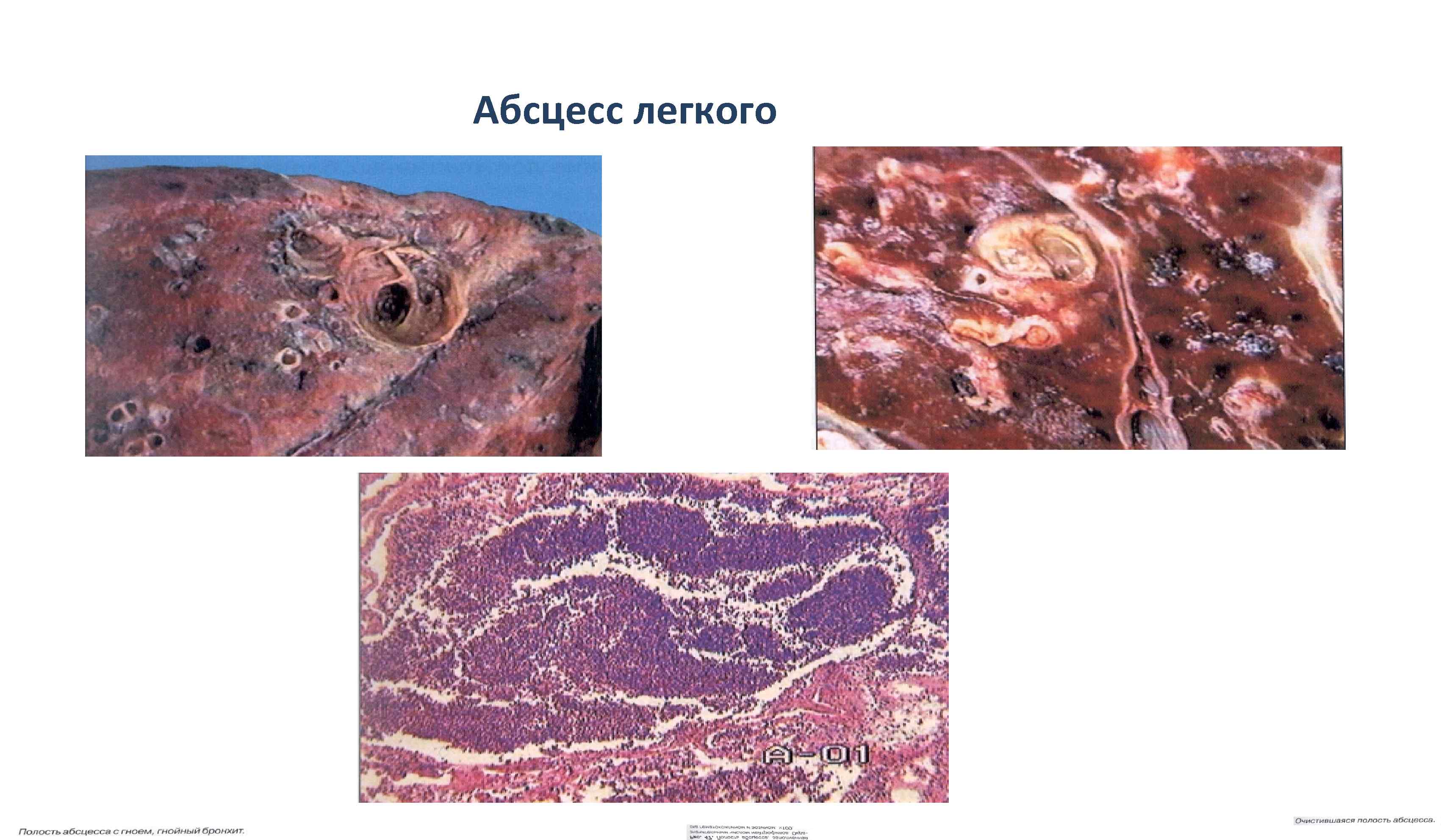Абсцесс легкого 