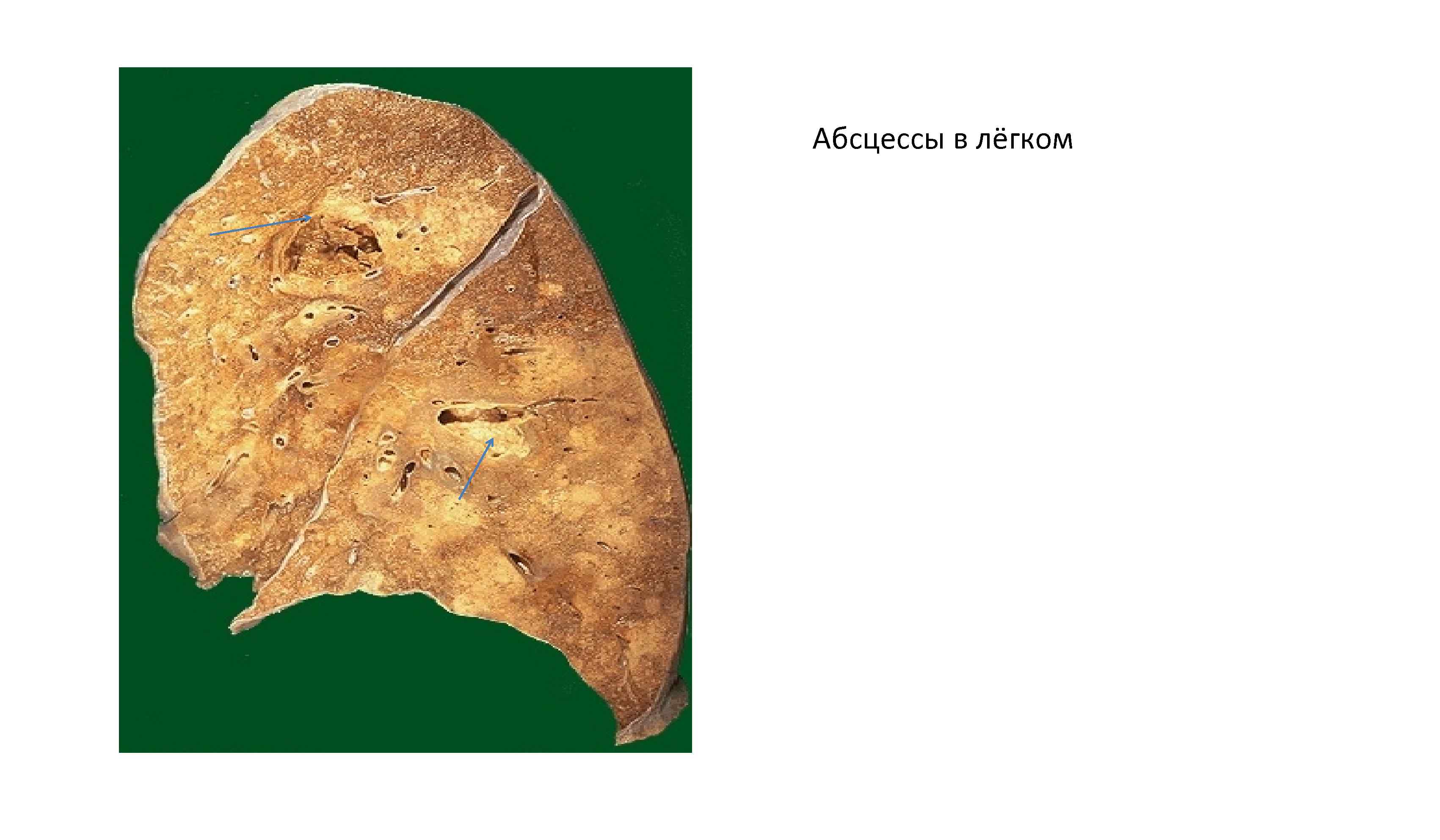 Абсцессы в лёгком 