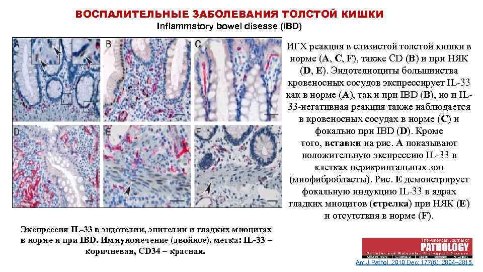 Заболевания толстой. Воспалительные заболевания толстой кишки. Заболевания Толстого кишечника классификация. Воспалительные заболевания Толстого кишечника.