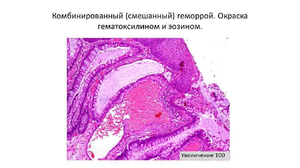 Ишемия кишки