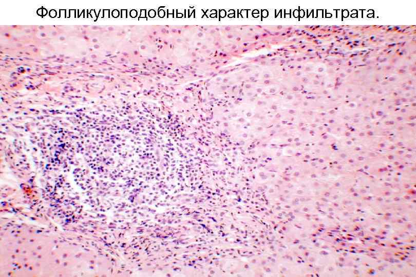 Фолликулоподобный характер инфильтрата. 