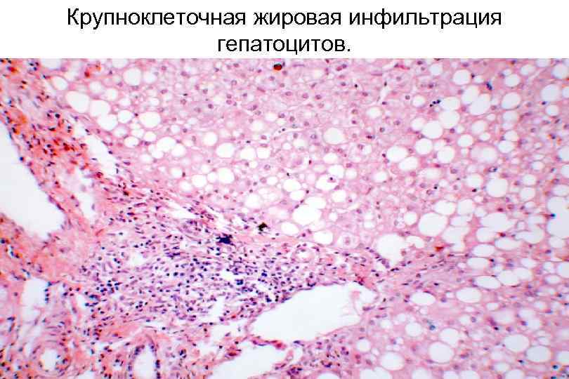 Крупноклеточная жировая инфильтрация гепатоцитов. 