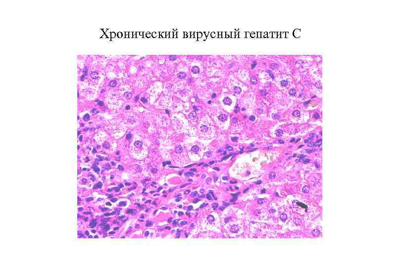 Хронический вирусный гепатит С 