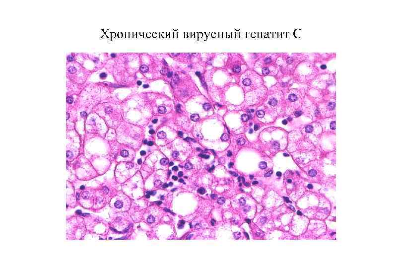 Хронический вирусный гепатит С 