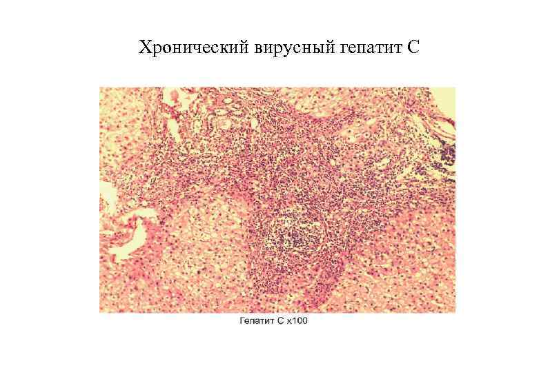 Хронический вирусный гепатит С 