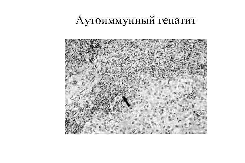 Аутоиммунный гепатит 
