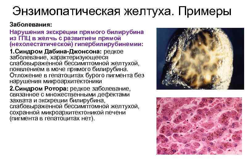 Энзимопатическая желтуха. Примеры Заболевания: Нарушения экскреции прямого билирубина из ГПЦ в желчь с развитием