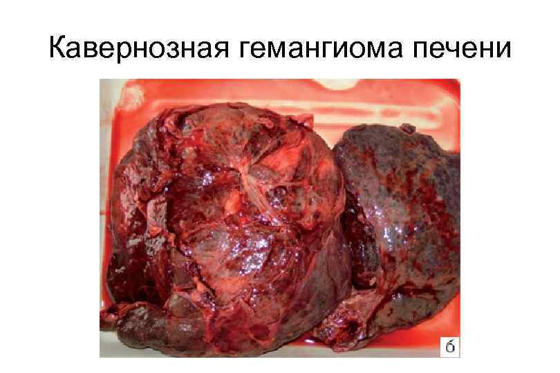 Кавернозная гемангиома печени 