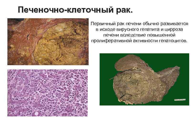 Печеночно клеточный рак. Первичный рак печени обычно развивается в исходе вирусного гепатита и цирроза