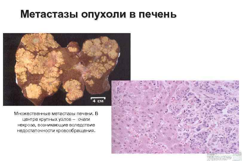 Метастазы опухоли в печень Множественные метастазы печени. В центре крупных узлов – очаги некроза,