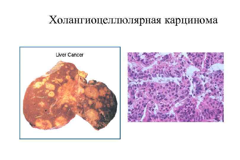 Холангиоцеллюлярная карцинома 