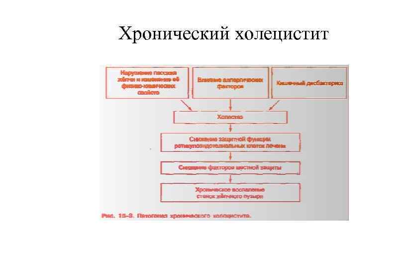 Хронический холецистит 