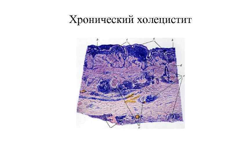 Хронический холецистит 