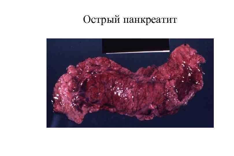 Острый панкреатит 