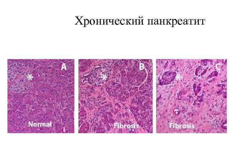 Хронический панкреатит 