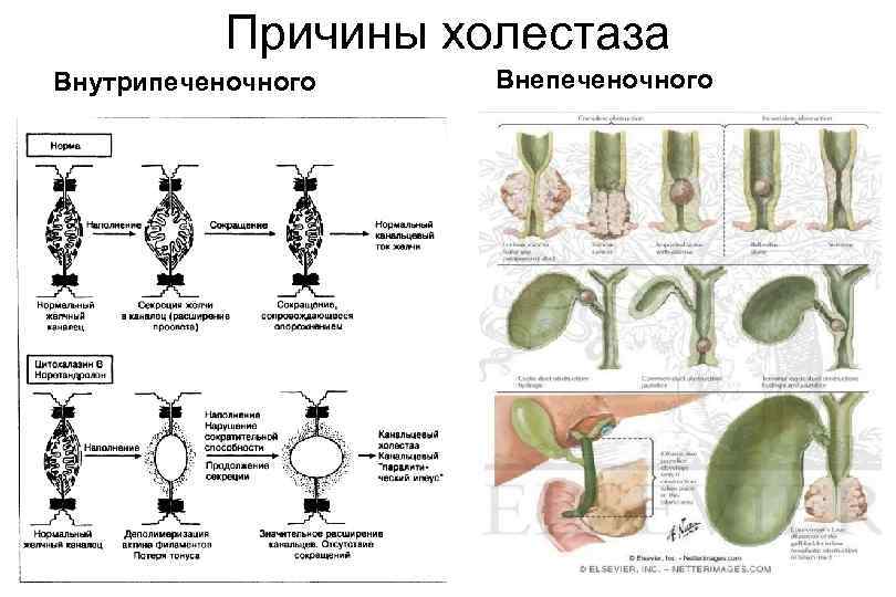 Причины холестаза Внутрипеченочного Внепеченочного 