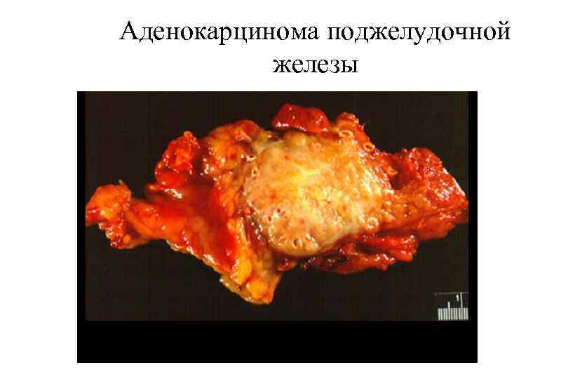 Аденокарцинома поджелудочной железы 