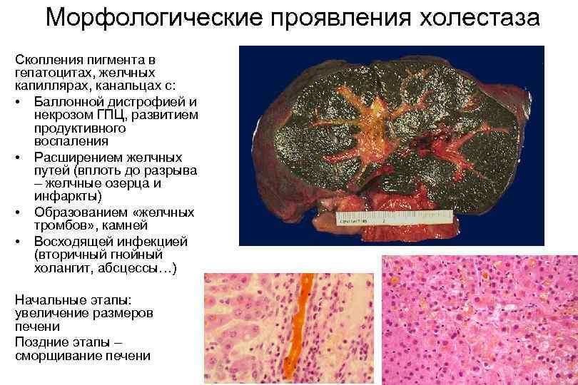 Цитологическая картина папиллярной карциномы