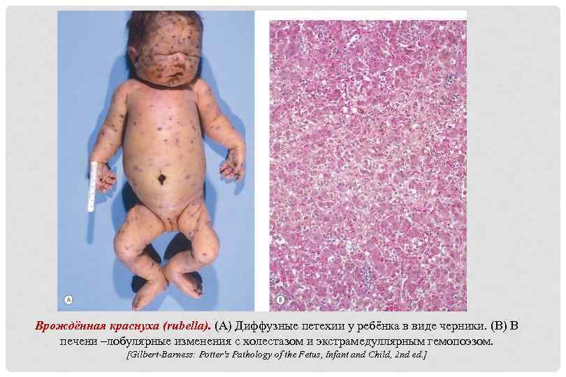 Врождённая краснуха (rubella). (A) Диффузные петехии у ребёнка в виде черники. (B) В печени