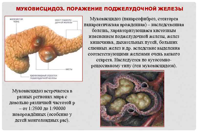 МУКОВИСЦИДОЗ. ПОРАЖЕНИЕ ПОДЖЕЛУДОЧНОЙ ЖЕЛЕЗЫ Муковисцидоз (панкреофиброз, стеаторея панкреатическая врожденная) – наследственная болезнь, характеризующаяся кистозным