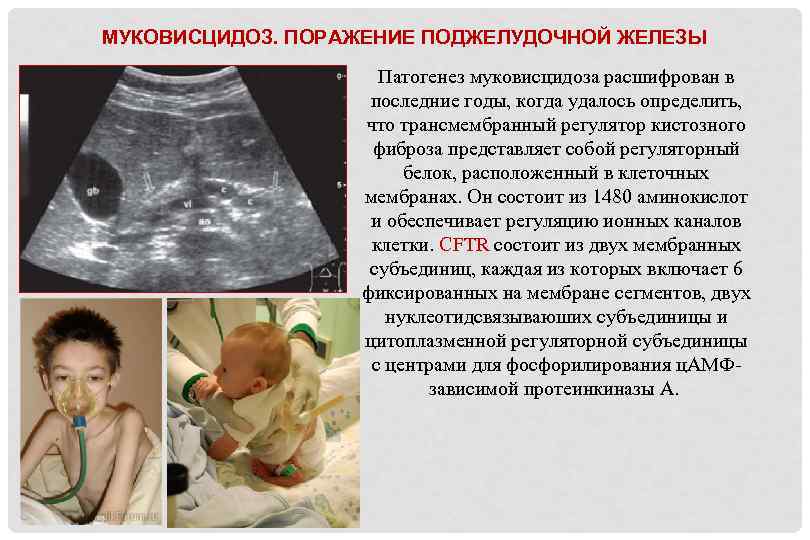 МУКОВИСЦИДОЗ. ПОРАЖЕНИЕ ПОДЖЕЛУДОЧНОЙ ЖЕЛЕЗЫ Патогенез муковисцидоза расшифрован в последние годы, когда удалось определить, что