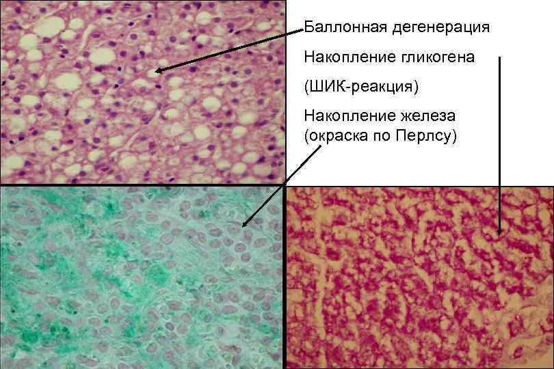 Баллонная дегенерация Накопление гликогена (ШИК реакция) Накопление железа (окраска по Перлсу) 
