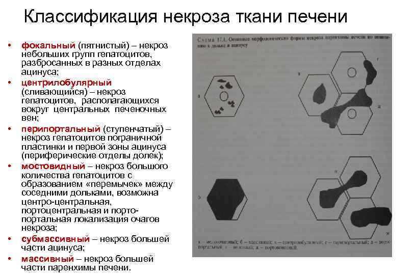 Классификация некроза ткани печени • • • фокальный (пятнистый) – некроз небольших групп гепатоцитов,