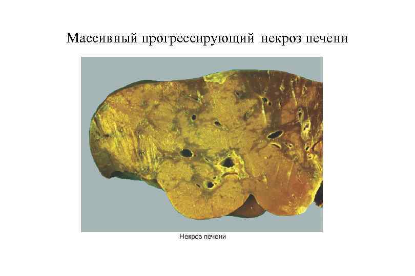 Массивный прогрессирующий некроз печени 