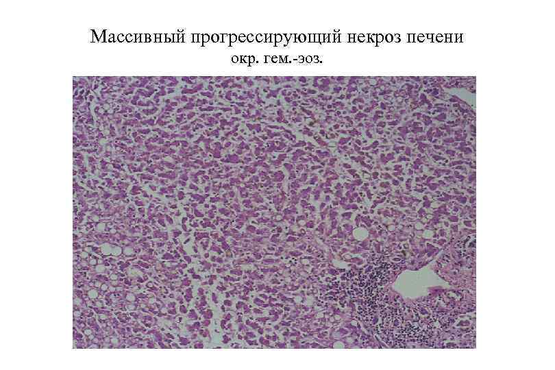 Печень при эклампсии микропрепарат рисунок