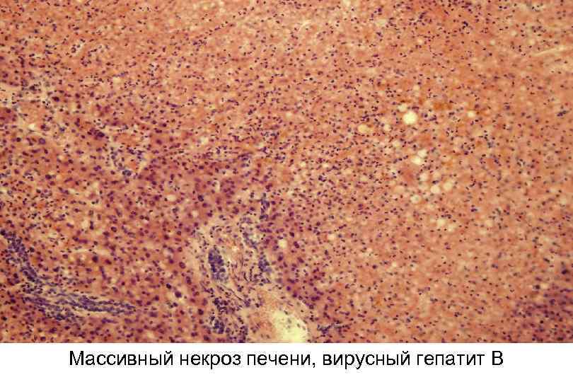 Массивный некроз печени, вирусный гепатит В 
