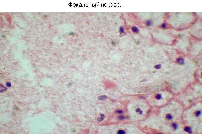 Фокальный некроз. 