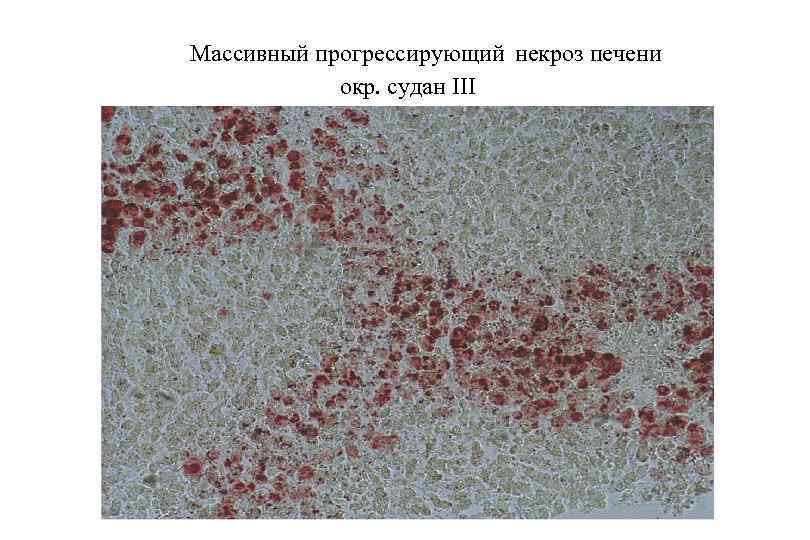  Массивный прогрессирующий некроз печени окр. судан III 