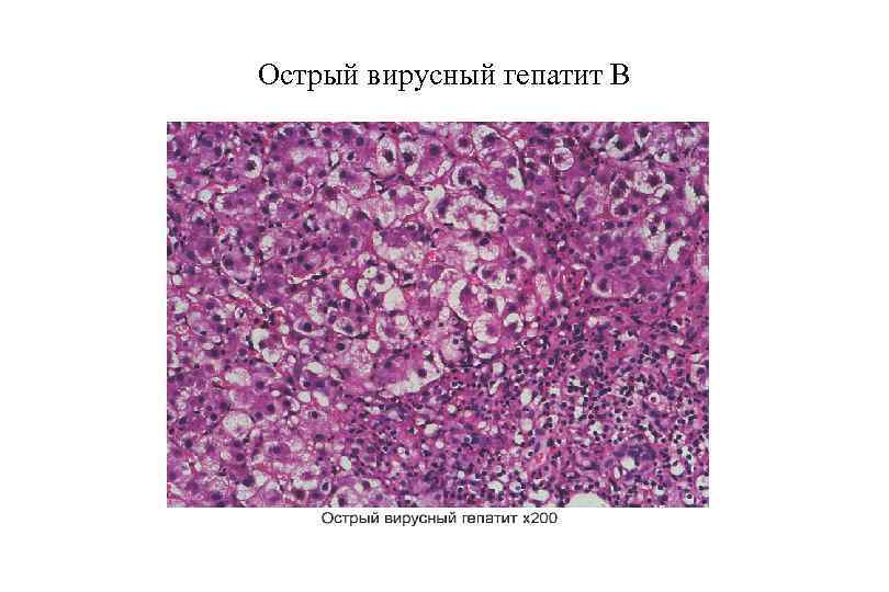 Острый вирусный гепатит В 