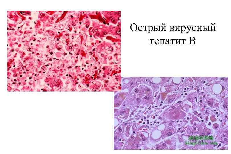 Острый вирусный гепатит В 