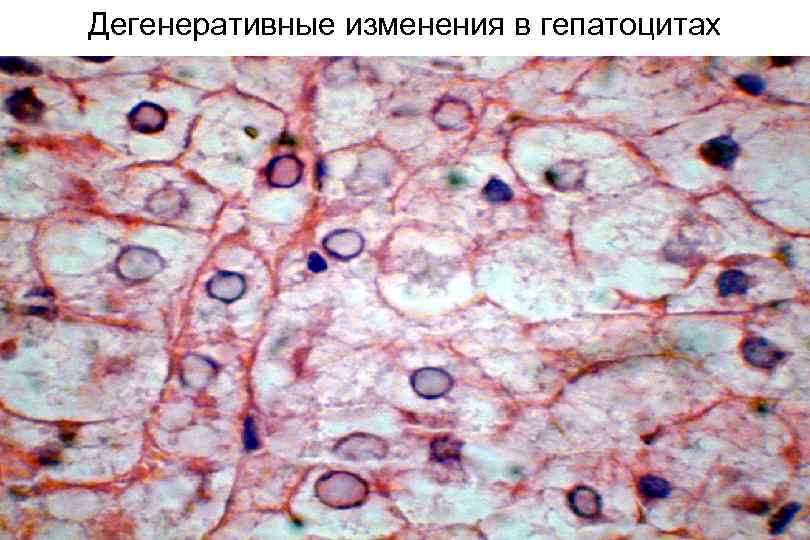 Дегенеративные изменения в гепатоцитах 