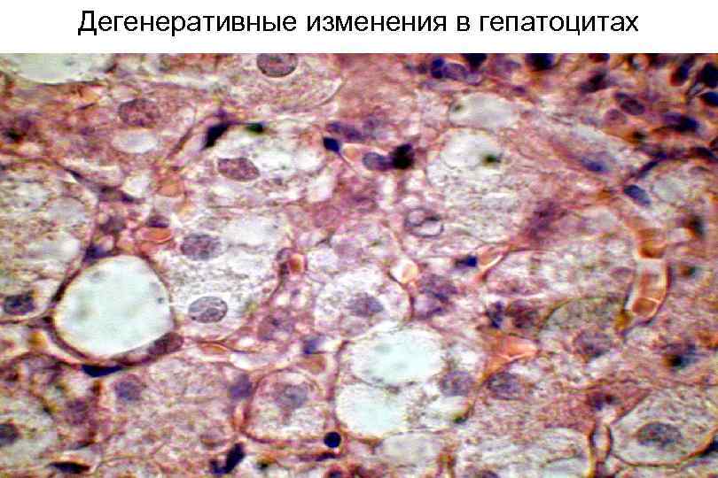 Дегенеративные изменения в гепатоцитах 