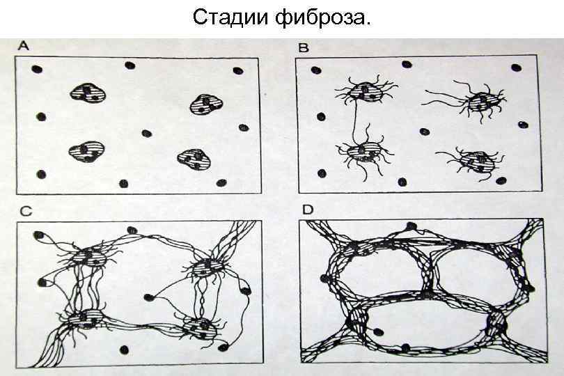Стадии фиброза. 