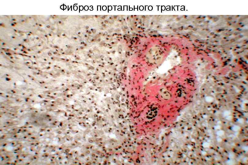 Фиброз портального тракта. 