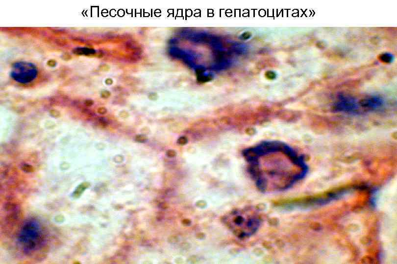  «Песочные ядра в гепатоцитах» 