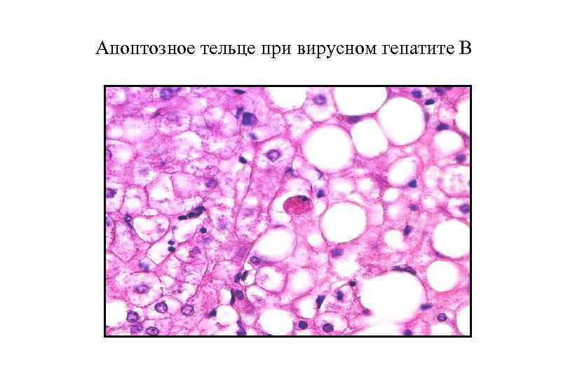 Апоптозное тельце при вирусном гепатите В 